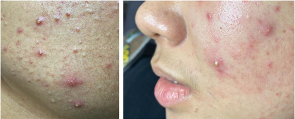 MỤN MỦ: Có nhân, kích thước <5mm