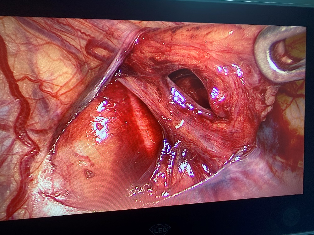 (Bệnh nhân được phẫu thuật tại khoa Ngoại tổng hợp – BVĐK Quảng Trị)