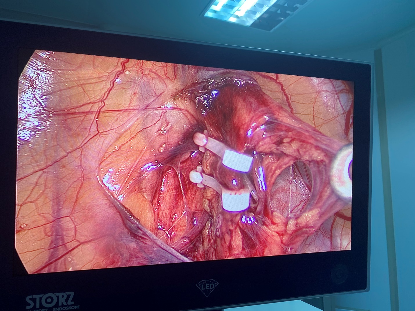 (Bệnh nhân được phẫu thuật tại khoa Ngoại tổng hợp – BVĐK Quảng Trị)