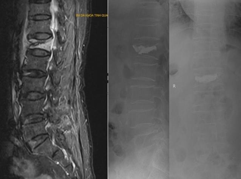 Hình ảnh bơm xi măng cột sống điều trị lún xẹp đốt sống