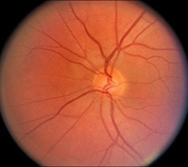 Gai thị bình thường