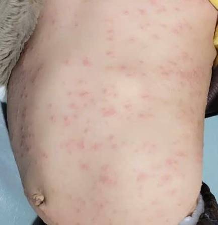 Tổn thương mụn nước, sẩn đỏ thân mình