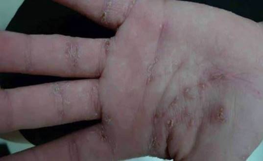 Đường hầm ghẻ ở đường chỉ bàn tay