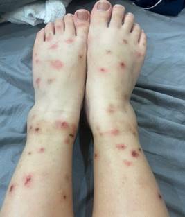 Triệu chứng lâm sàng khi bị bọ chét cắn