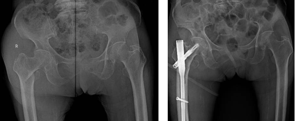 Đinh nội tuỷ PFNA