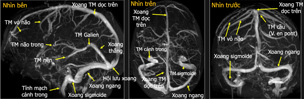 Hình 1: Giải phẩu hệ tĩnh mạch não