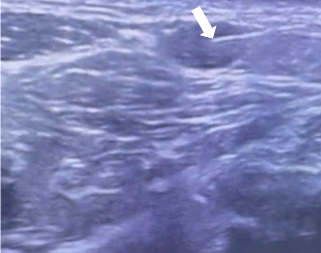 Đầu kim (mũi tên trắng) đi vào hạch dưới siêu âm